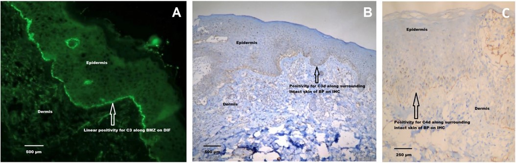 Representative image of C3d and C4d-positivity immunohistochemistry results.